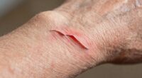 skin tear prevention strategies